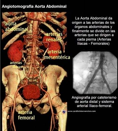 aorta-abdominal.jpg